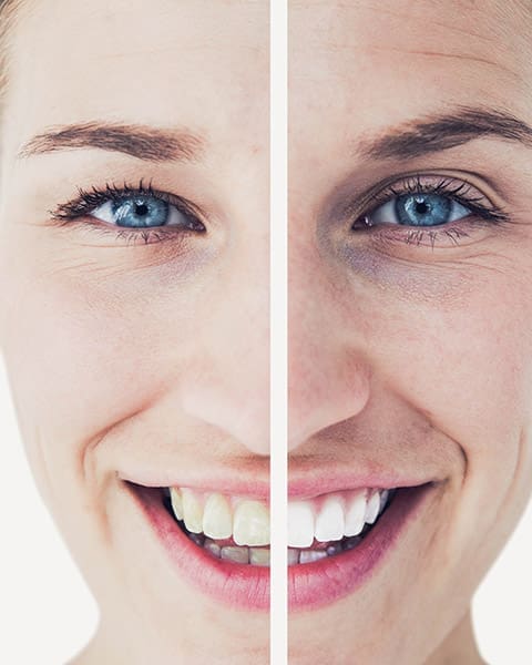 Before and After Cosmetic Dentistry